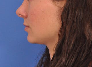 Cheek Filler Before & After Gallery - Patient 385411 - Image 12