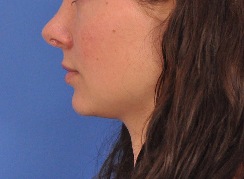 Cheek Filler Before & After Gallery - Patient 385411 - Image 12