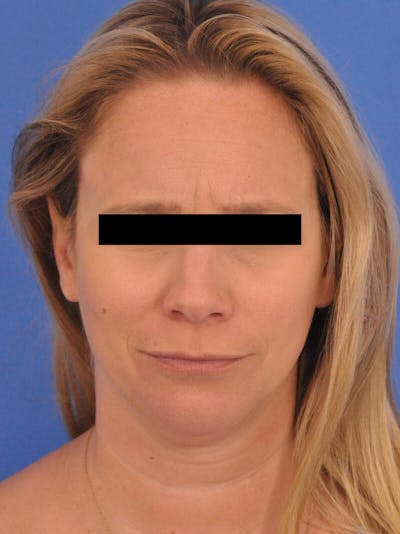 BOTOX Before & After Gallery - Patient 749775 - Image 1