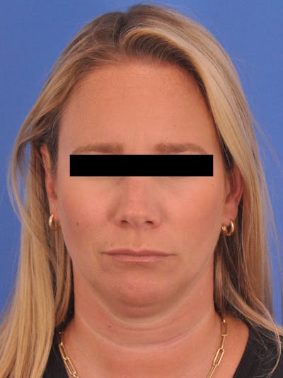 BOTOX Before & After Gallery - Patient 749775 - Image 2