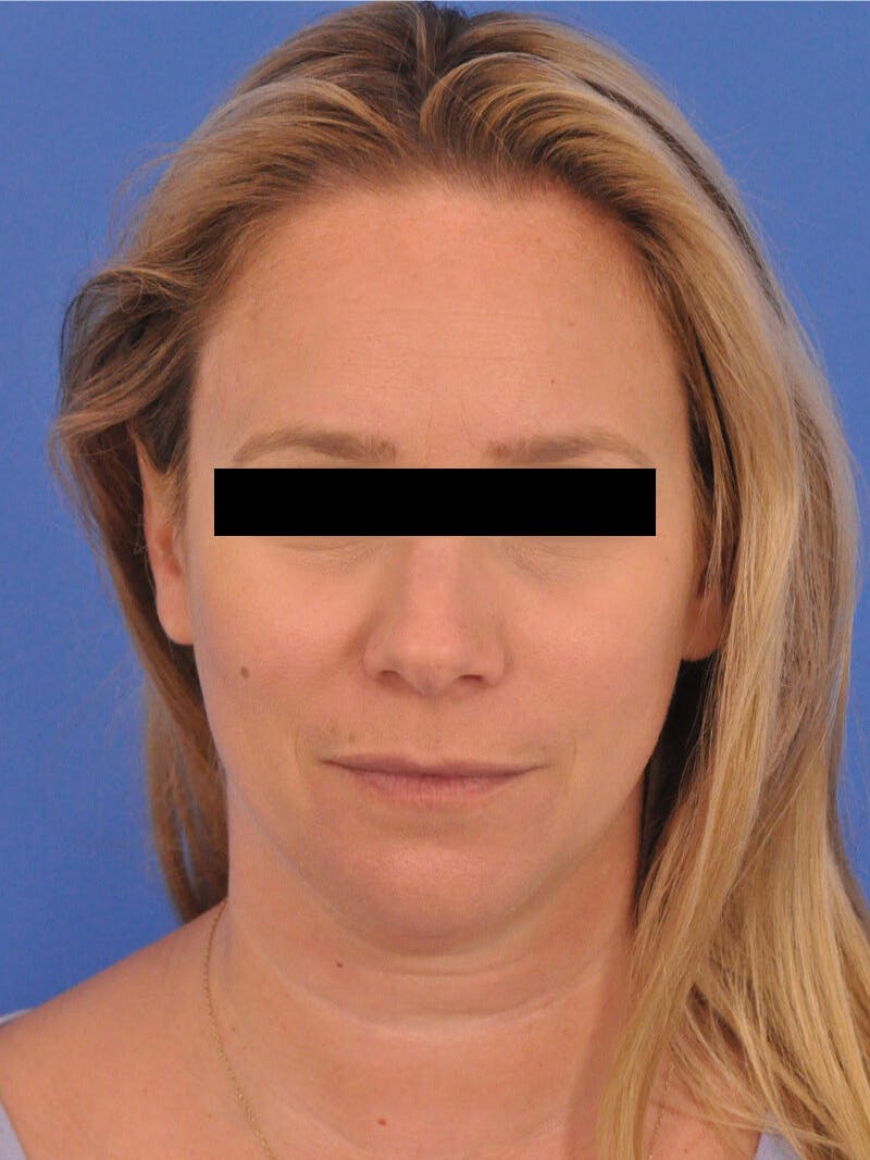 BOTOX Before & After Gallery - Patient 749775 - Image 3