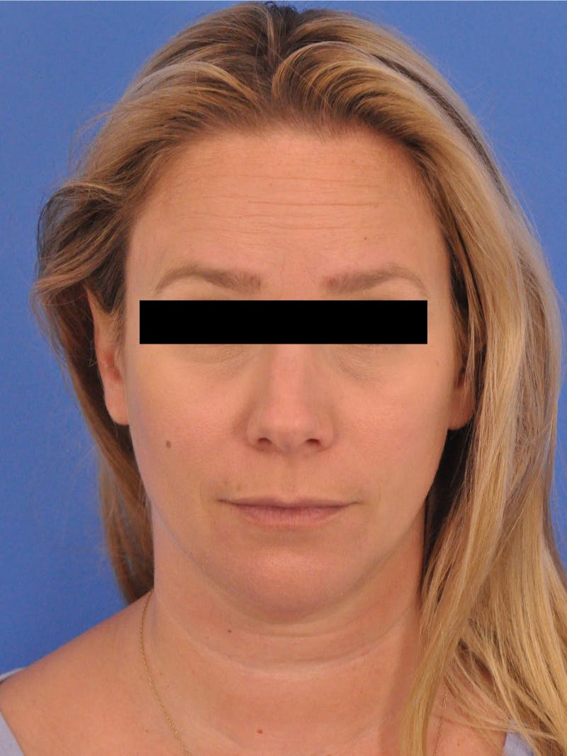 BOTOX Before & After Gallery - Patient 749775 - Image 5
