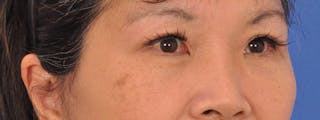 Blepharoplasty Before & After Gallery - Patient 110153 - Image 4
