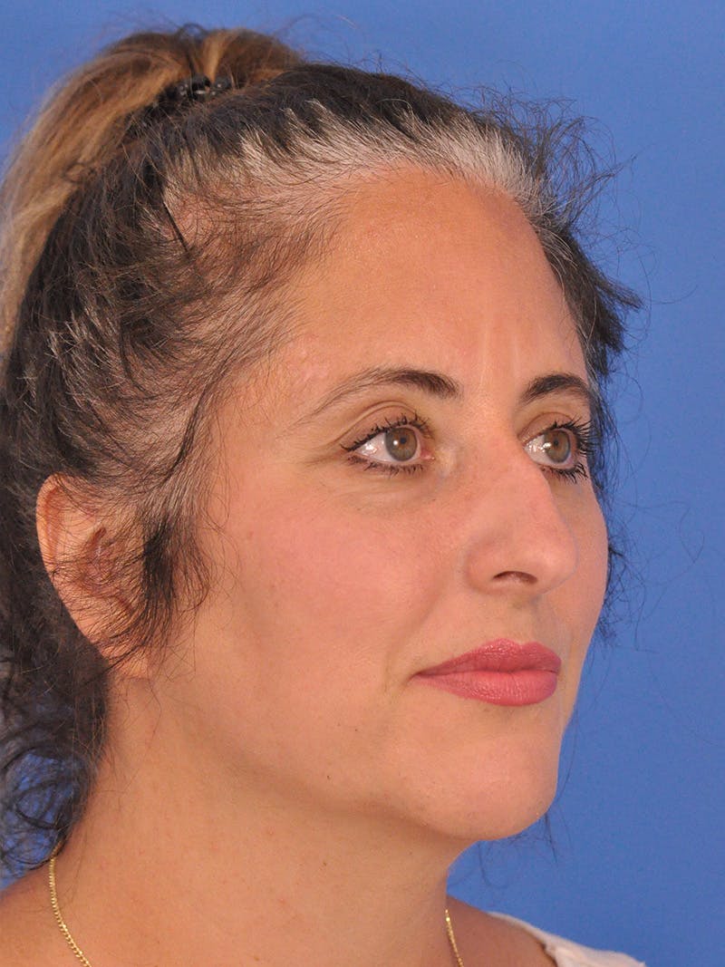 Rhinoplasty Before & After Gallery - Patient 347488 - Image 3