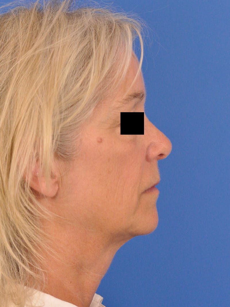 Neck Lift Before & After Gallery - Patient 102804 - Image 1