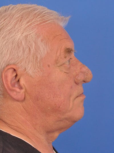 Rhinoplasty Before & After Gallery - Patient 100708 - Image 1