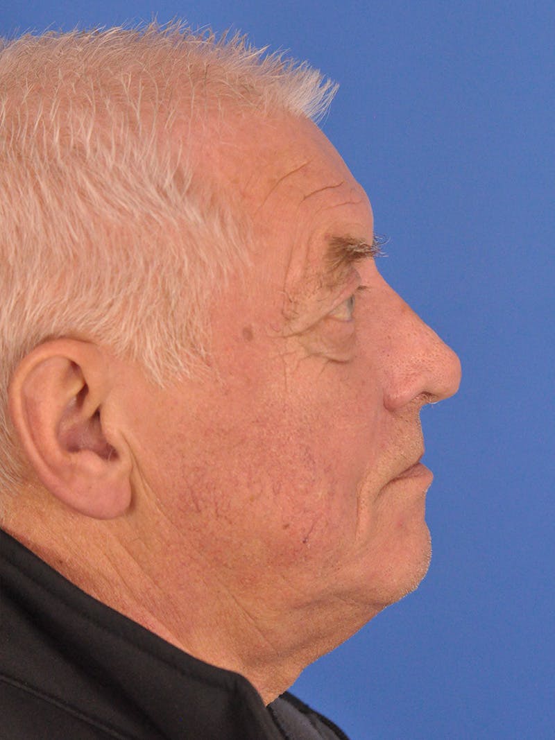 Rhinoplasty Before & After Gallery - Patient 100708 - Image 2