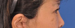 Blepharoplasty Before & After Gallery - Patient 110153 - Image 6
