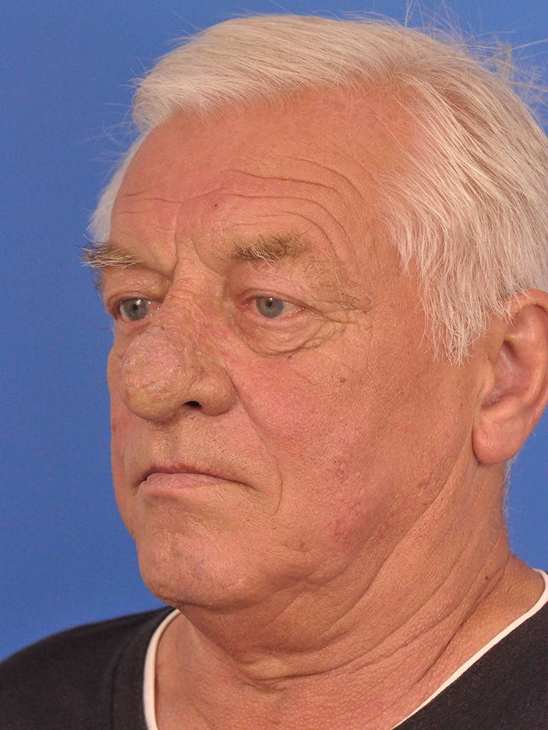 Rhinoplasty Before & After Gallery - Patient 100708 - Image 7