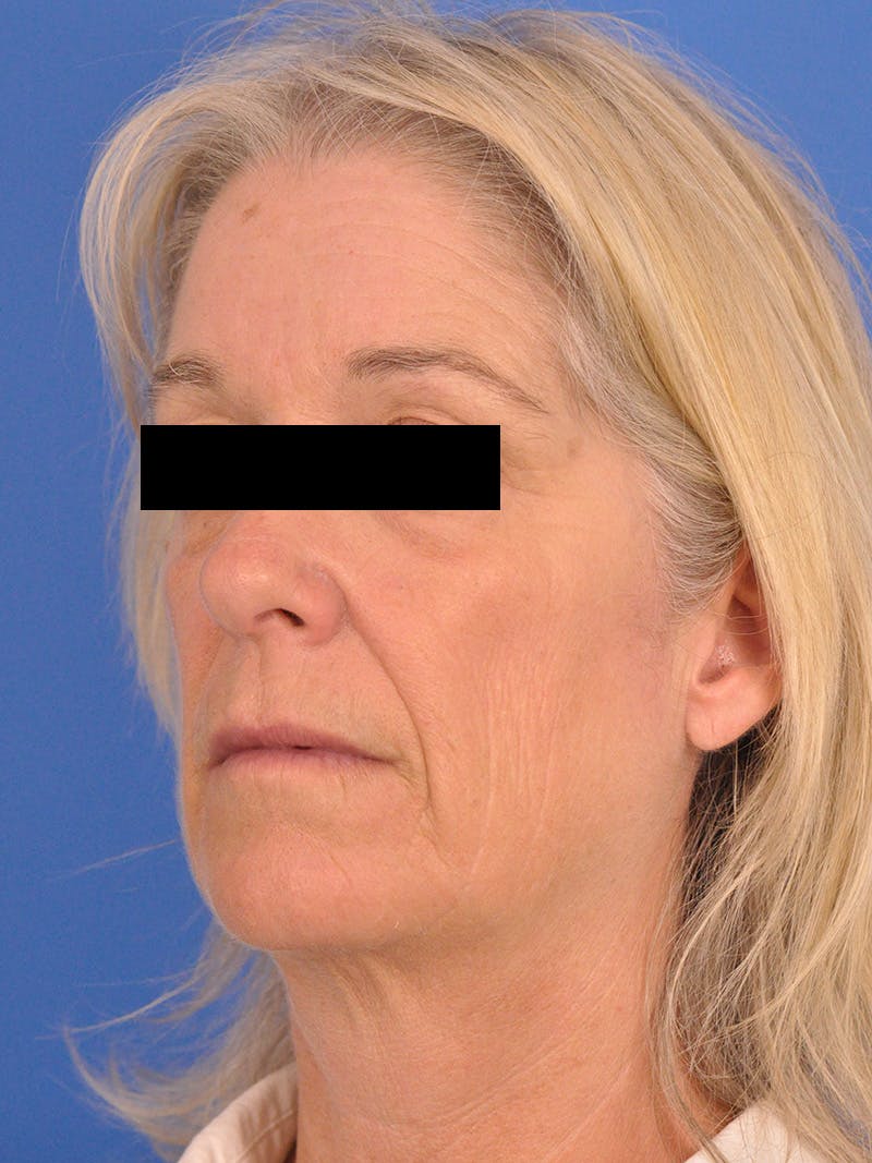 Neck Lift Before & After Gallery - Patient 102804 - Image 7