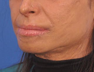 Lip Lift Before & After Gallery - Patient 380904 - Image 6