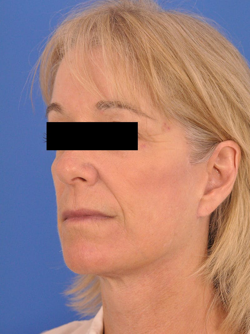 Neck Lift Before & After Gallery - Patient 102804 - Image 8