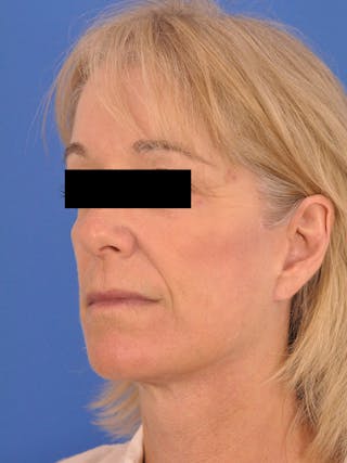 Neck Lift Before & After Gallery - Patient 102804 - Image 8