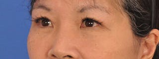 Blepharoplasty Before & After Gallery - Patient 110153 - Image 8