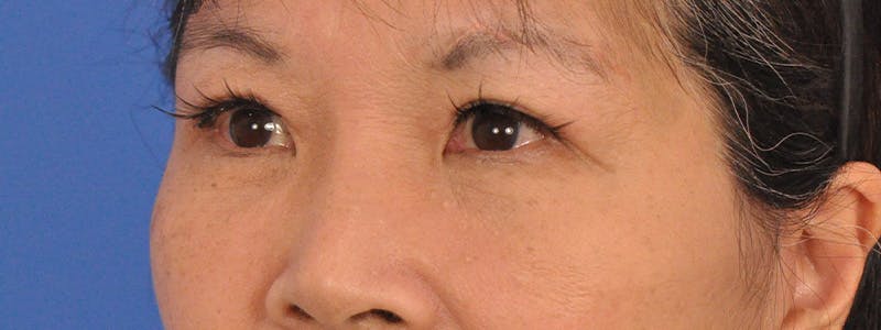 Blepharoplasty Before & After Gallery - Patient 110153 - Image 8