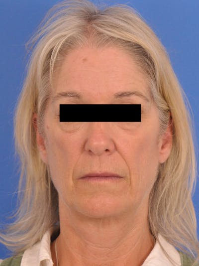 Facelift Before & After Gallery - Patient 874963 - Image 1