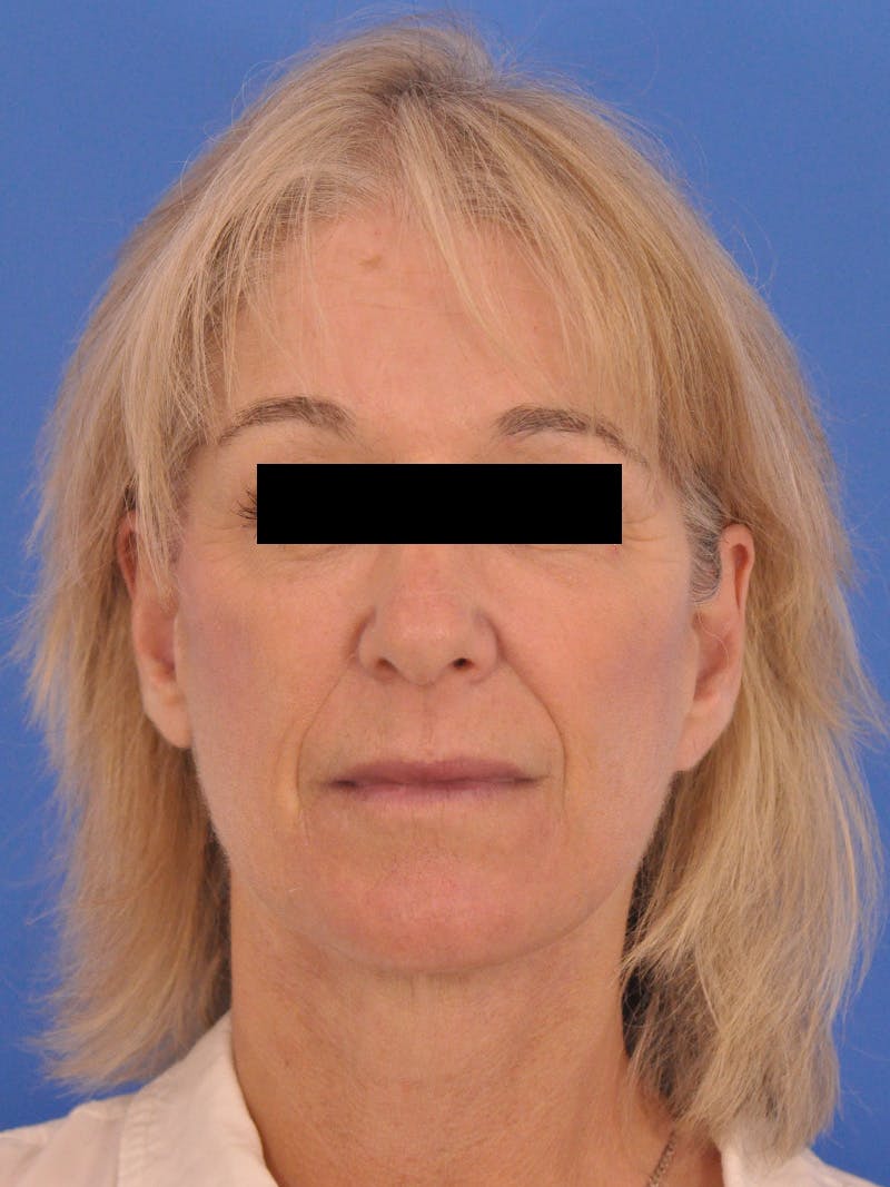 Neck Lift Before & After Gallery - Patient 102804 - Image 6