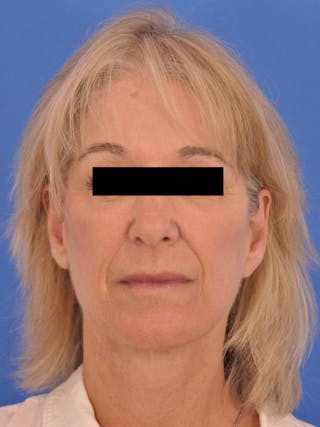 Neck Lift Before & After Gallery - Patient 102804 - Image 6