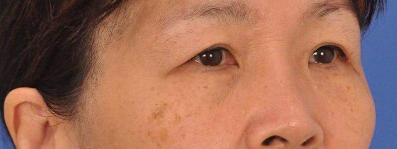 Blepharoplasty Before & After Gallery - Patient 110153 - Image 3