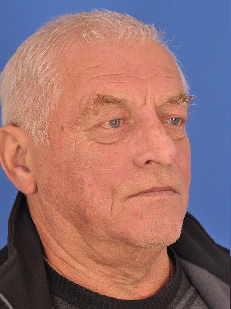 Rhinoplasty Before & After Gallery - Patient 100708 - Image 4