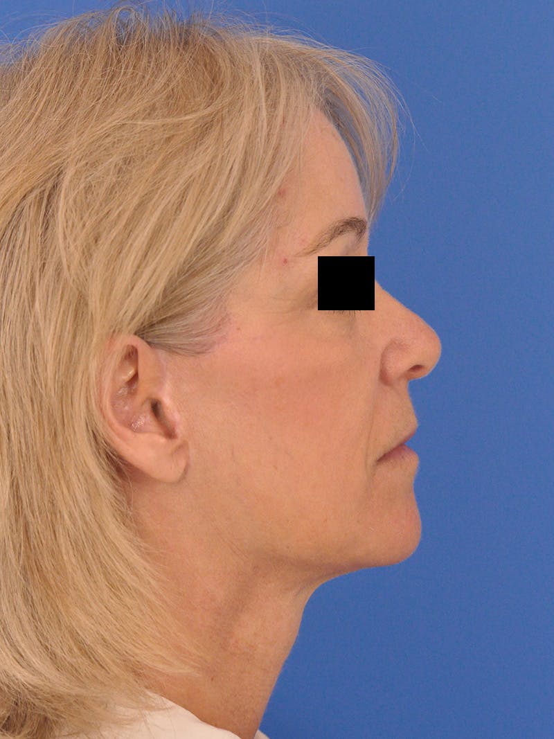 Neck Lift Before & After Gallery - Patient 102804 - Image 2
