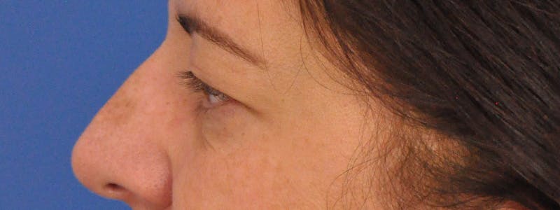 Blepharoplasty Before & After Gallery - Patient 378731 - Image 9