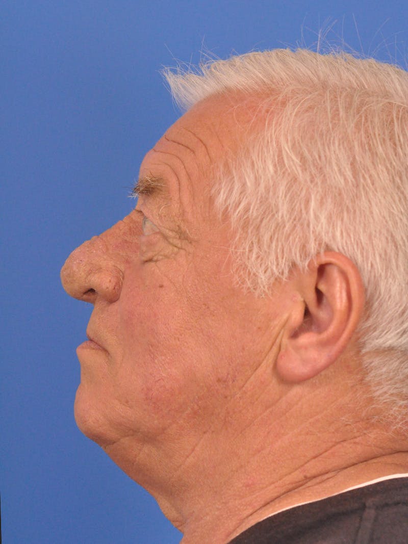 Rhinoplasty Before & After Gallery - Patient 100708 - Image 11