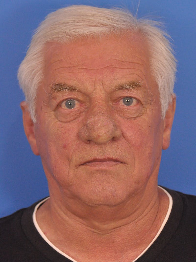 Rhinoplasty Before & After Gallery - Patient 100708 - Image 5