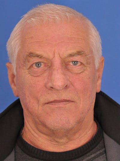 CO2RE Laser Before & After Gallery - Patient 232792 - Image 2