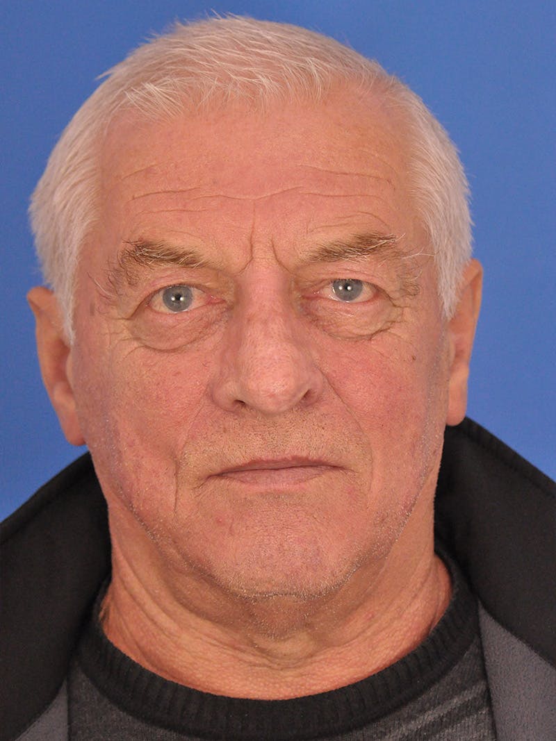 Rhinoplasty Before & After Gallery - Patient 100708 - Image 6