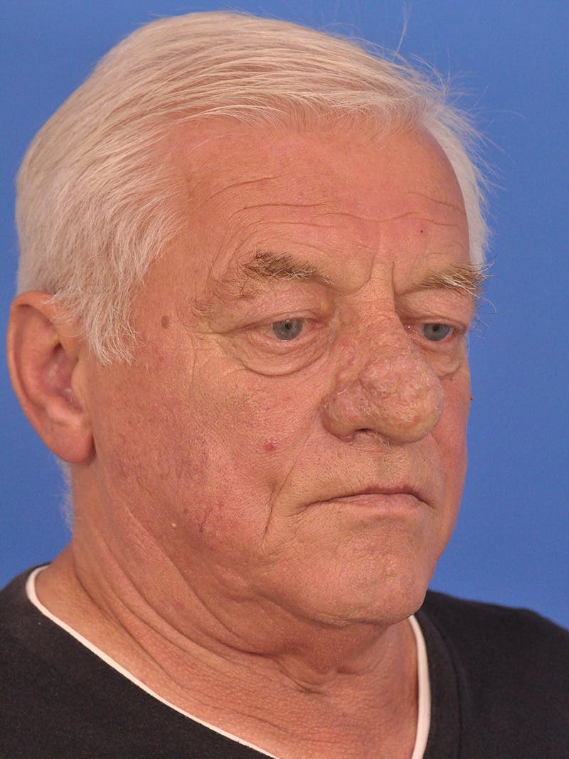 Rhinoplasty Before & After Gallery - Patient 100708 - Image 3