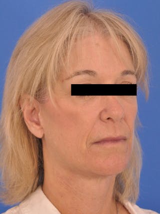 Neck Lift Before & After Gallery - Patient 102804 - Image 4
