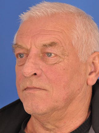 Rhinoplasty Before & After Gallery - Patient 100708 - Image 8