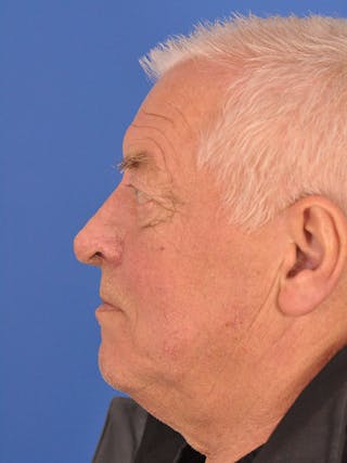 Rhinoplasty Before & After Gallery - Patient 100708 - Image 12