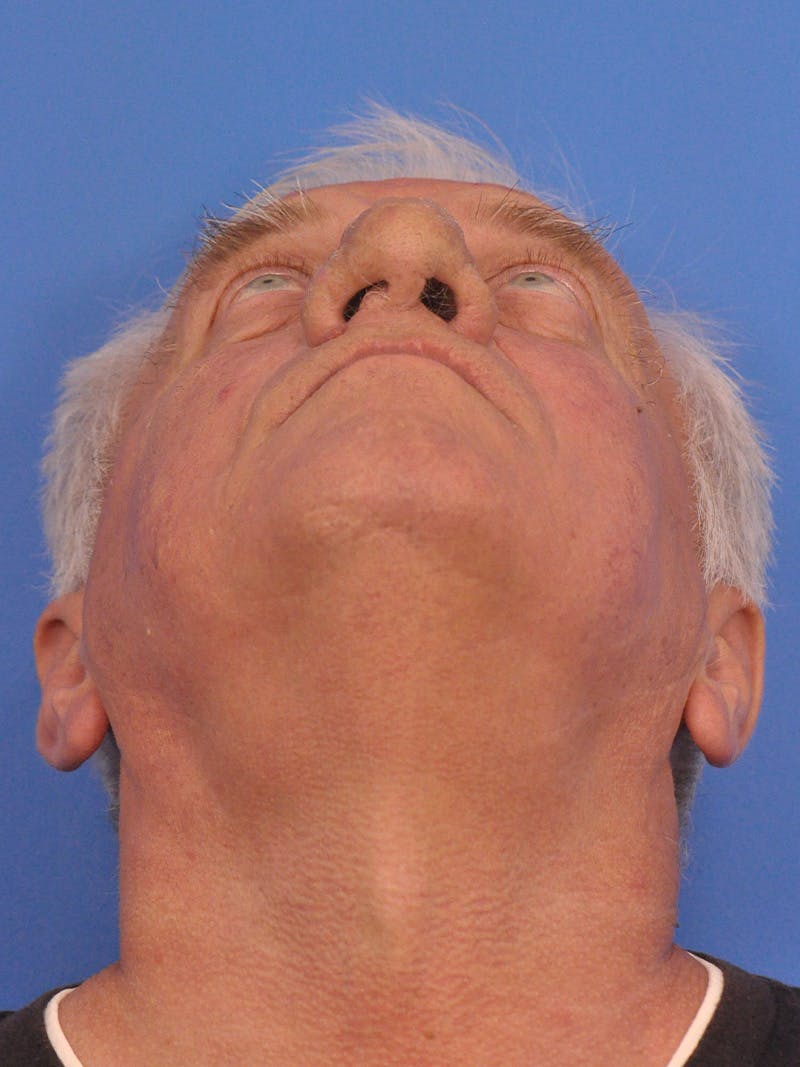 Rhinoplasty Before & After Gallery - Patient 100708 - Image 9