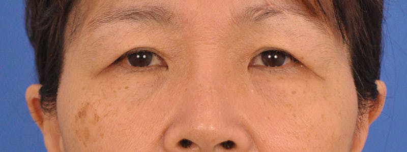 Blepharoplasty Before & After Gallery - Patient 110153 - Image 1