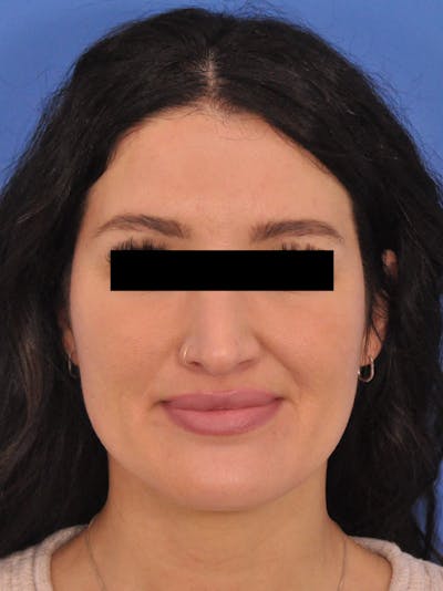 Brow Lift Before & After Gallery - Patient 233430 - Image 1