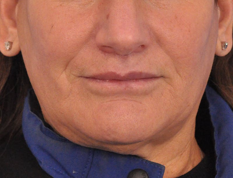 Lip Lift Before & After Gallery - Patient 271870 - Image 2
