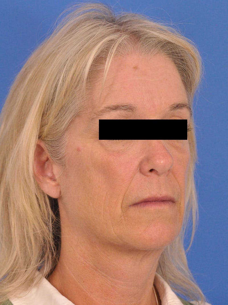 Neck Lift Before & After Gallery - Patient 102804 - Image 3