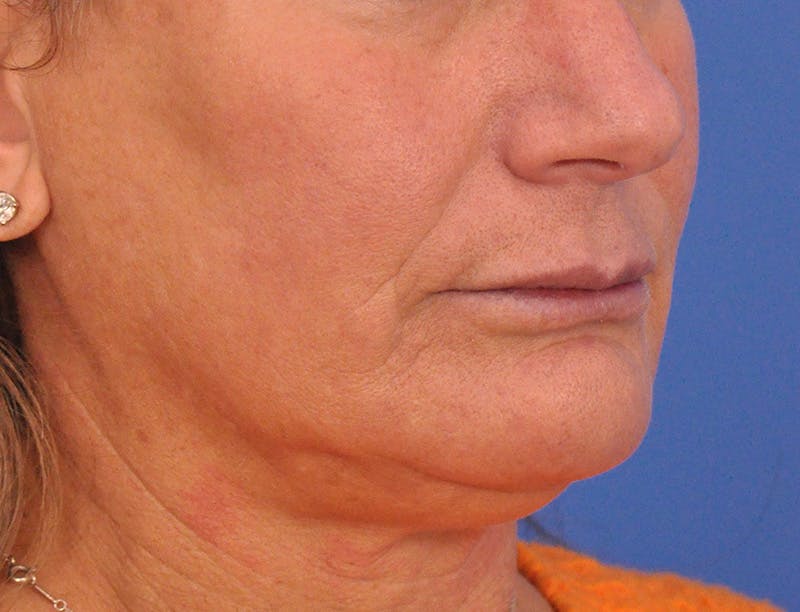 Lip Lift Before & After Gallery - Patient 271870 - Image 6