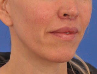 Lip Lift Before & After Gallery - Patient 336999 - Image 6