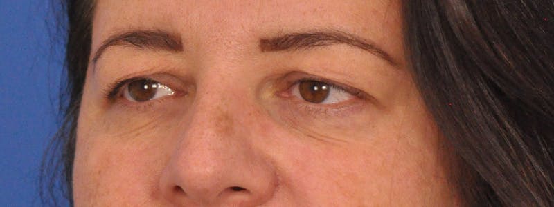Blepharoplasty Before & After Gallery - Patient 378731 - Image 7