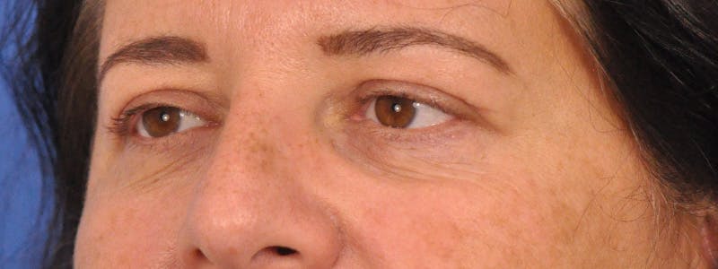 Blepharoplasty Before & After Gallery - Patient 378731 - Image 8