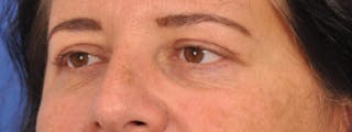 Blepharoplasty Before & After Gallery - Patient 378731 - Image 8