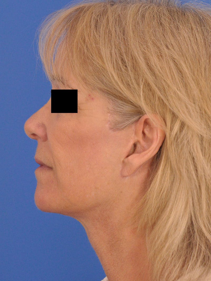 Neck Lift Before & After Gallery - Patient 102804 - Image 10