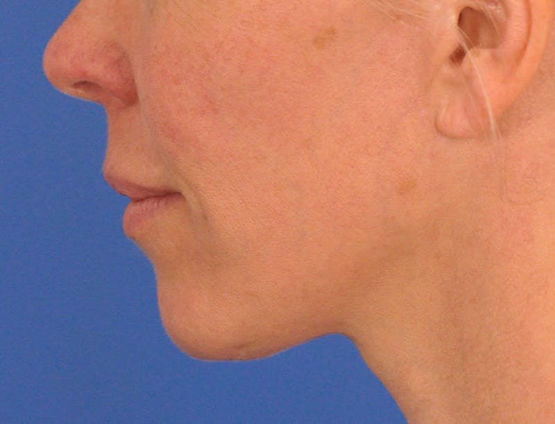 Lip Lift Before & After Gallery - Patient 336999 - Image 11