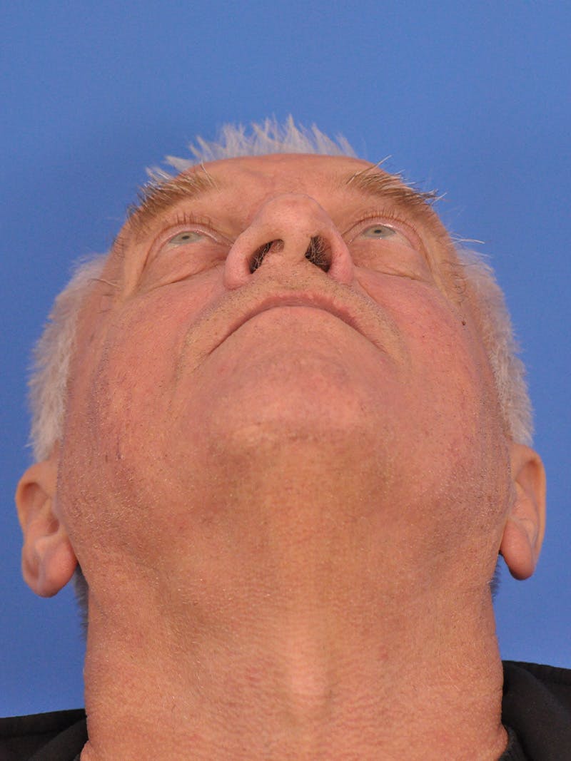 Rhinoplasty Before & After Gallery - Patient 100708 - Image 10