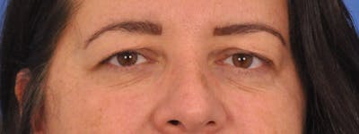 Blepharoplasty Before & After Gallery - Patient 378731 - Image 1