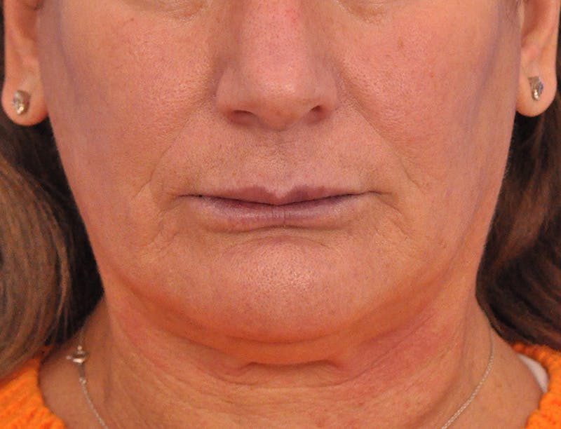 Lip Lift Before & After Gallery - Patient 271870 - Image 1