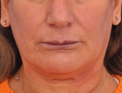 Lip Lift Before & After Gallery - Patient 271870 - Image 1